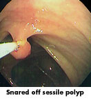 polyp1