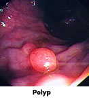 Colon Polyps