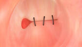 overstitch