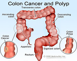 colon cancer resized 600