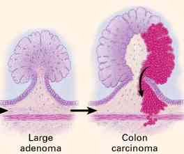 colon-cancer-prevention