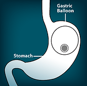 lgBalloon-Diagram