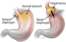 hiatial hernia