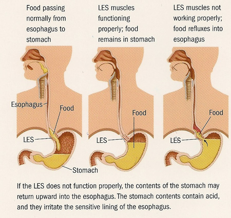 reflux gerd heartburn how heartburn works
