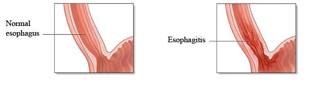 Esophagitis 2