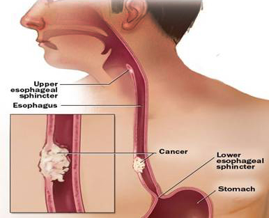 Reflux and Esophageal Cancer