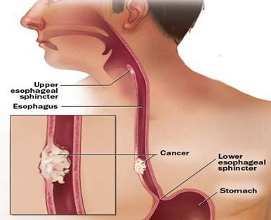 cancer-of-esophagus cancer-of-esophagus