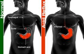 incisionless-anti-reflux-therapy-a-chance-to-stop-your-reflux-drugs