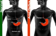 incisionless-anti-reflux-therapy-a-chance-to-stop-your-reflux-drugs