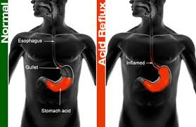 normal vs acid reflux lungs