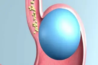 stomach balloon stomach balloon