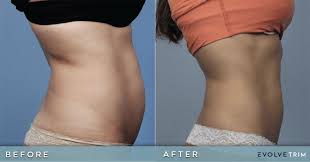 body contouring