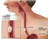 reflux-and-esophageal-cancer