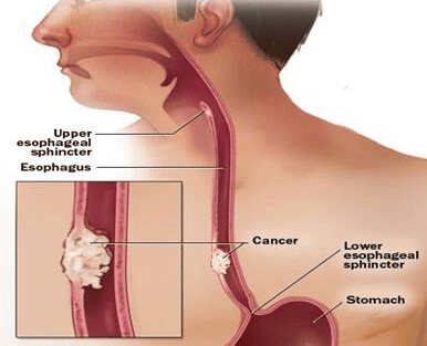cancer-of-oesophagus