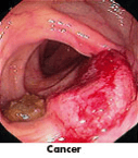 colon cancer