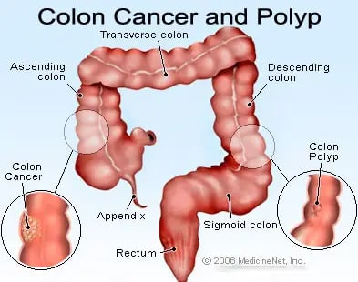 study-finds-colonoscopy-safe-and-effective