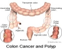 colon cancer and polyps