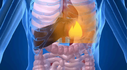 lose-weight-how-to-avoid-acid-reflux