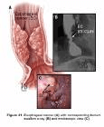 esophageal cancer pic resized 600