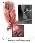 esophageal_cancer_pic-resized-600