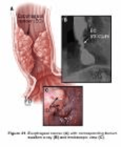 five-factors-implicated-in-the-rise-in-esophageal-cancer