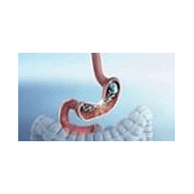 Nonsurgical Sleeve (ESG)