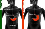 incisionless-anti-reflux-therapy-a-chance-to-stop-your-reflux-drugs