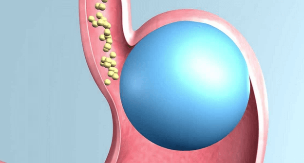 gastric-balloon-an-alternative-to-the-lap-band-for-weight-loss