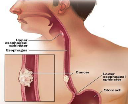 reflux-and-esophageal-cancer