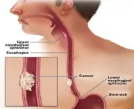 reflux-and-esophageal-cancer