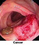 colon cancer